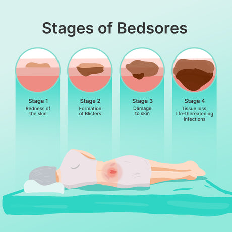 Choosing the Right Dressing for Pressure Ulcers